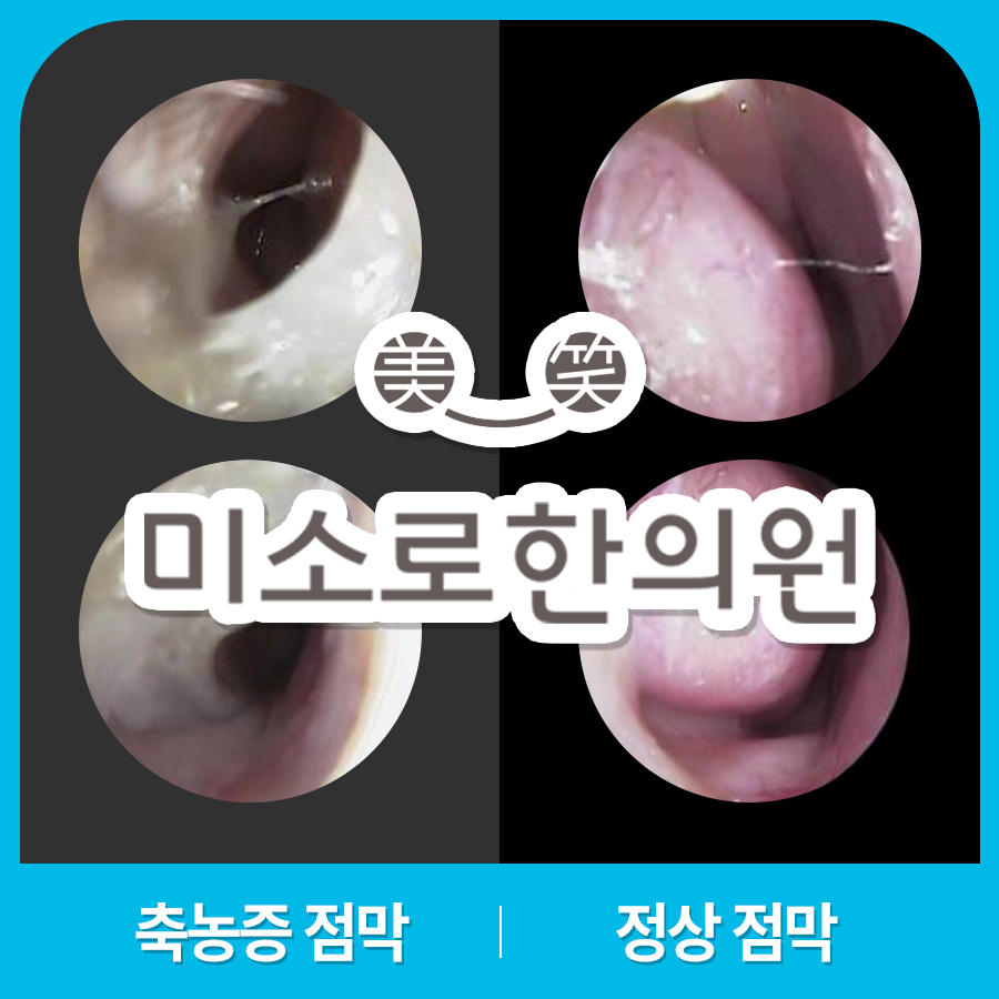 경기광주 비염 축농증 수술 관련 이미지 1