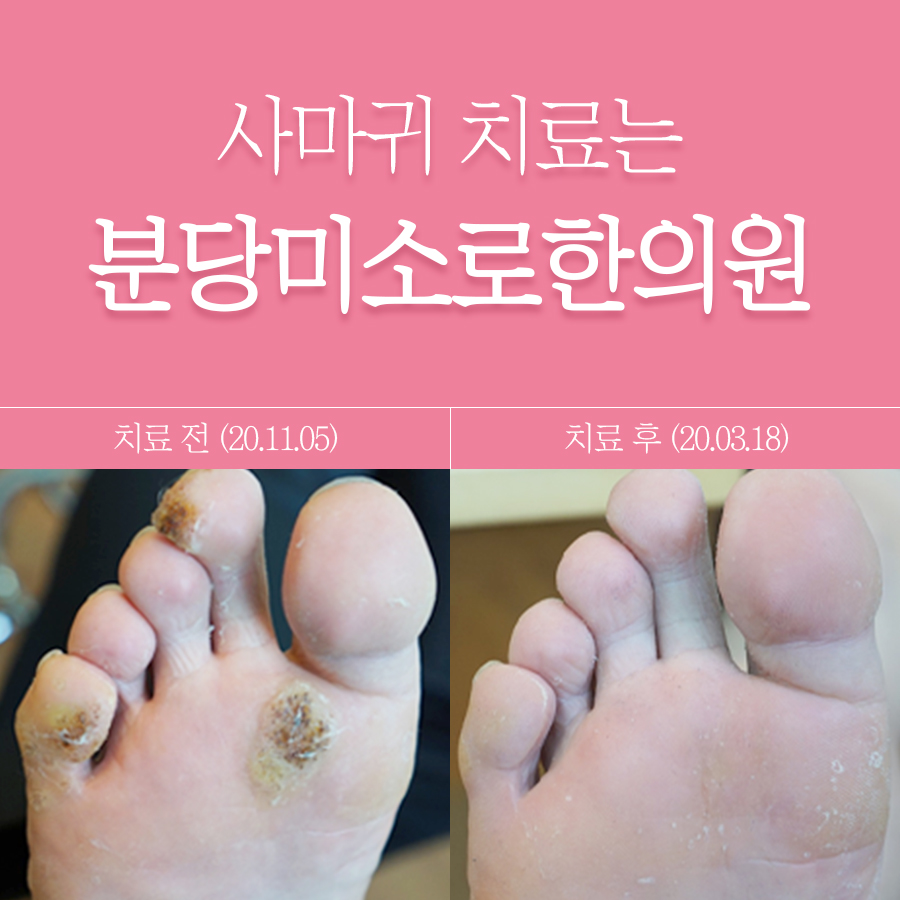 분당 목 사마귀 제거 후기 관련 이미지 1