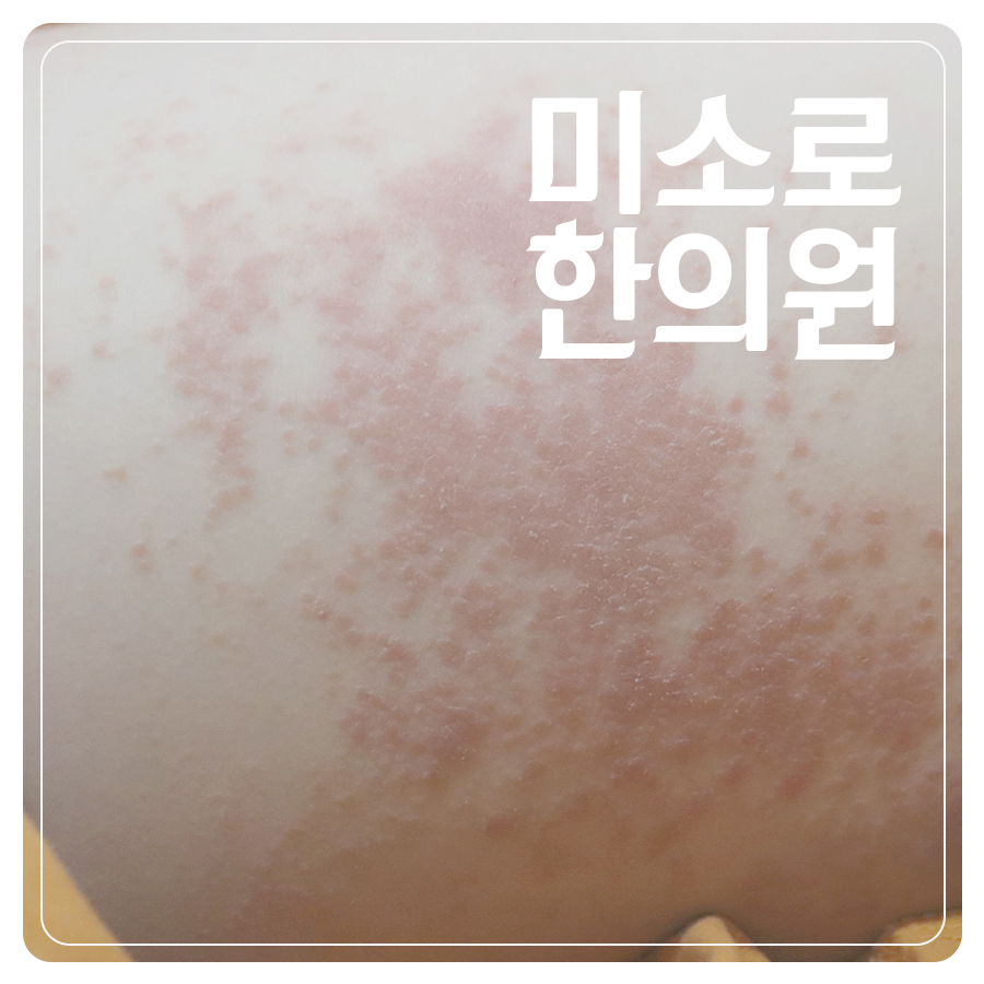 경기광주 지루성피부염 병원 추천 관련 이미지 1
