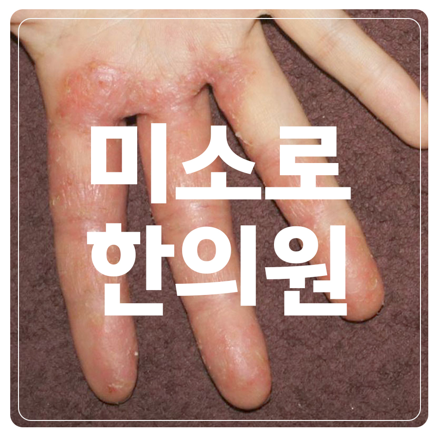 분당 발 한포진 연고 관련 이미지 1
