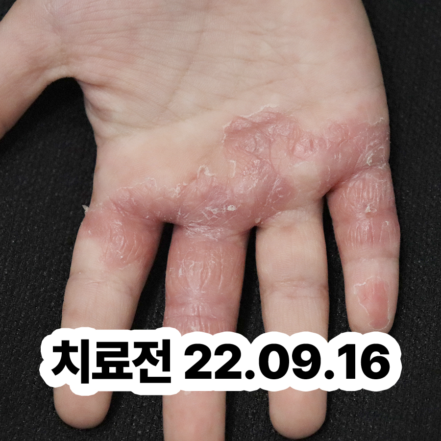 이천 손 한포진 물집 관련 이미지 2