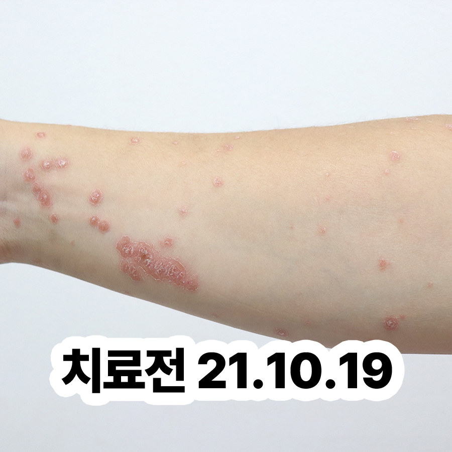 분당 건선 치료 한의원 관련 이미지 2