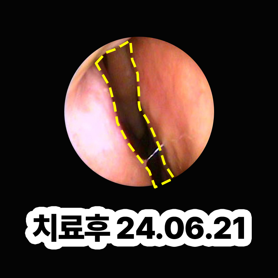 이천 비염치료비용 관련 이미지 3
