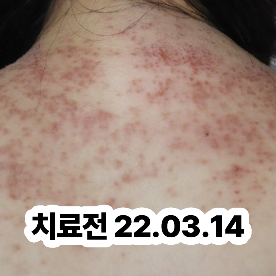 위례 사타구니 습진 병원 어디로 관련 이미지 2