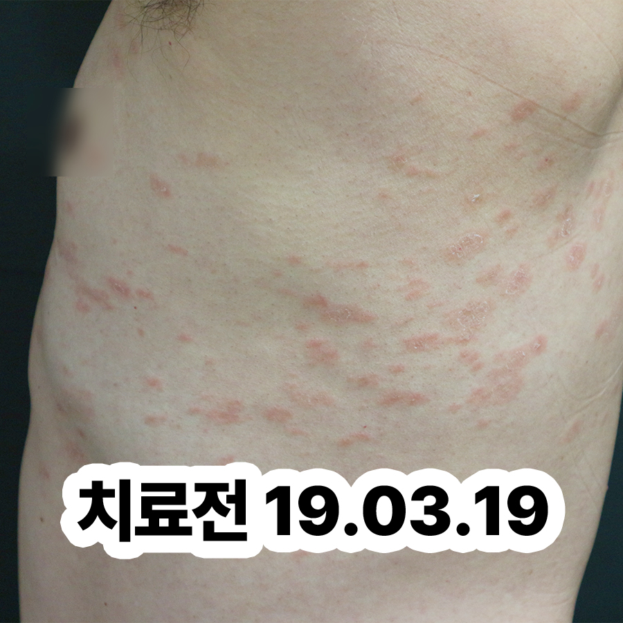 불당 건선 피부염 원인 관련 이미지 2