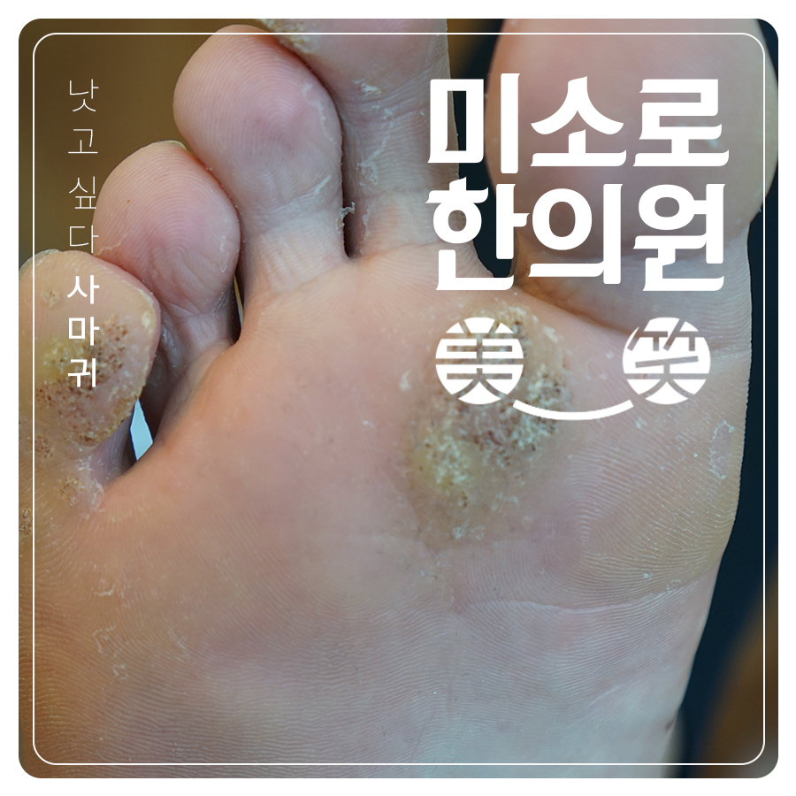 여주 편사마귀 원인 관련 이미지 1