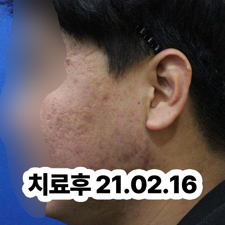 분당 지루성피부염 치료 관련 이미지 3
