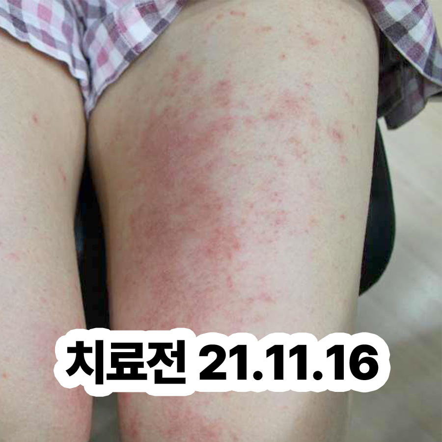 분당 알레르기 두드러기 병원 어디로 관련 이미지 2