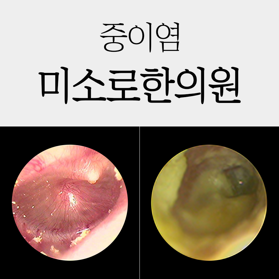 중이염 증상 관련 이미지 1