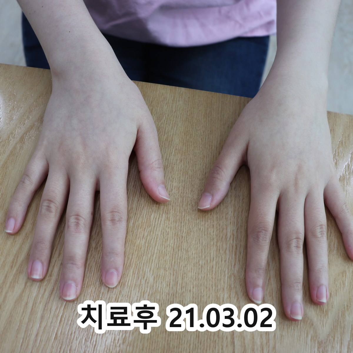 고덕 한포진 원인 관련 이미지 3