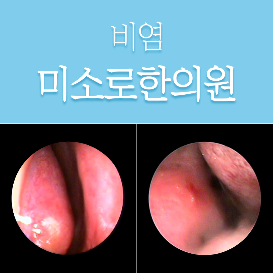 경기광주 비염수술잘하는병원 관련 이미지 1