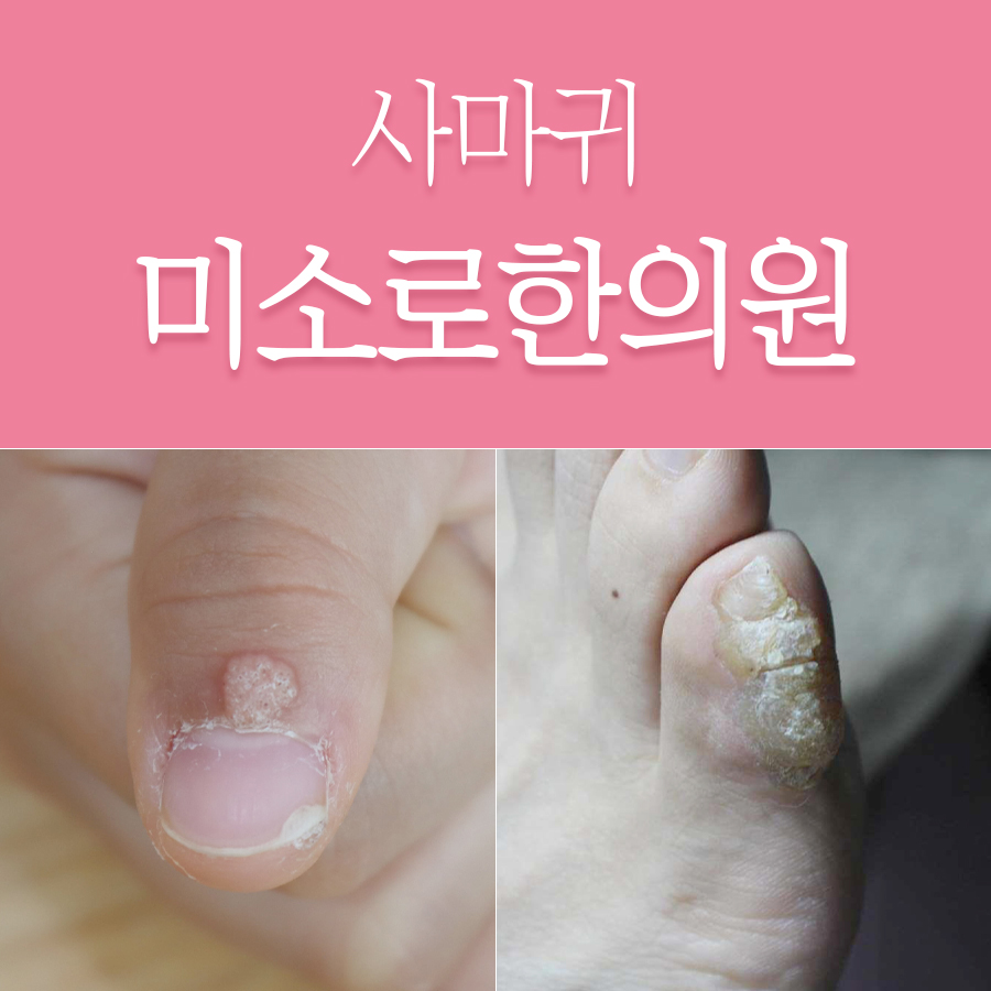 분당 한의원 사마귀 관련 이미지 1