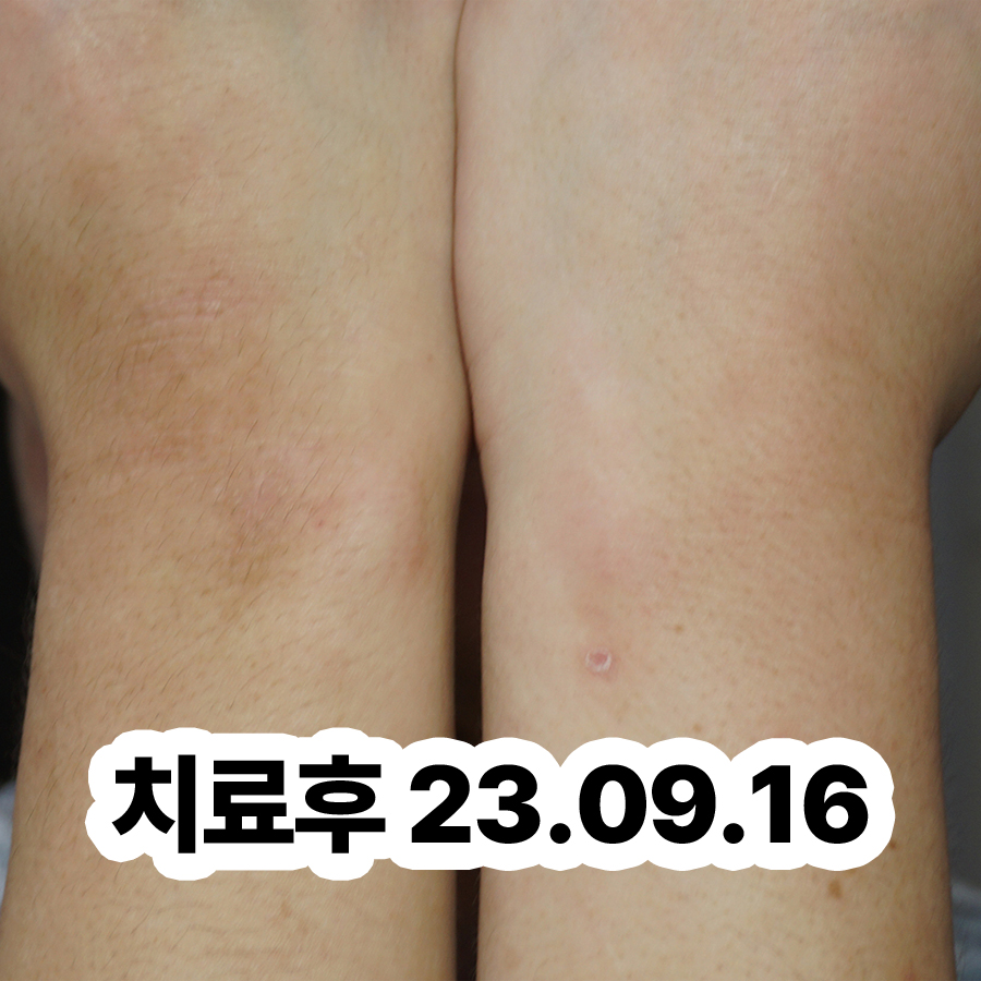 분당 아토피 치료제 관련 이미지 3