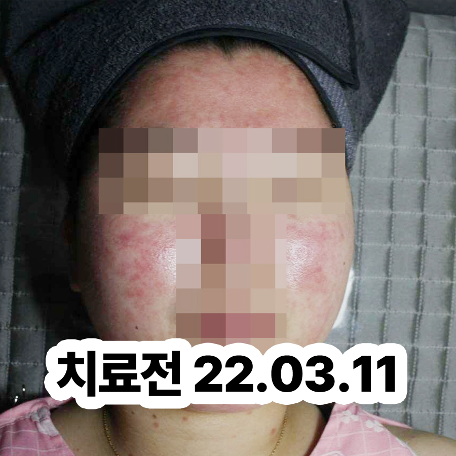 여주 지루성 피부염 피부과 명의 관련 이미지 2
