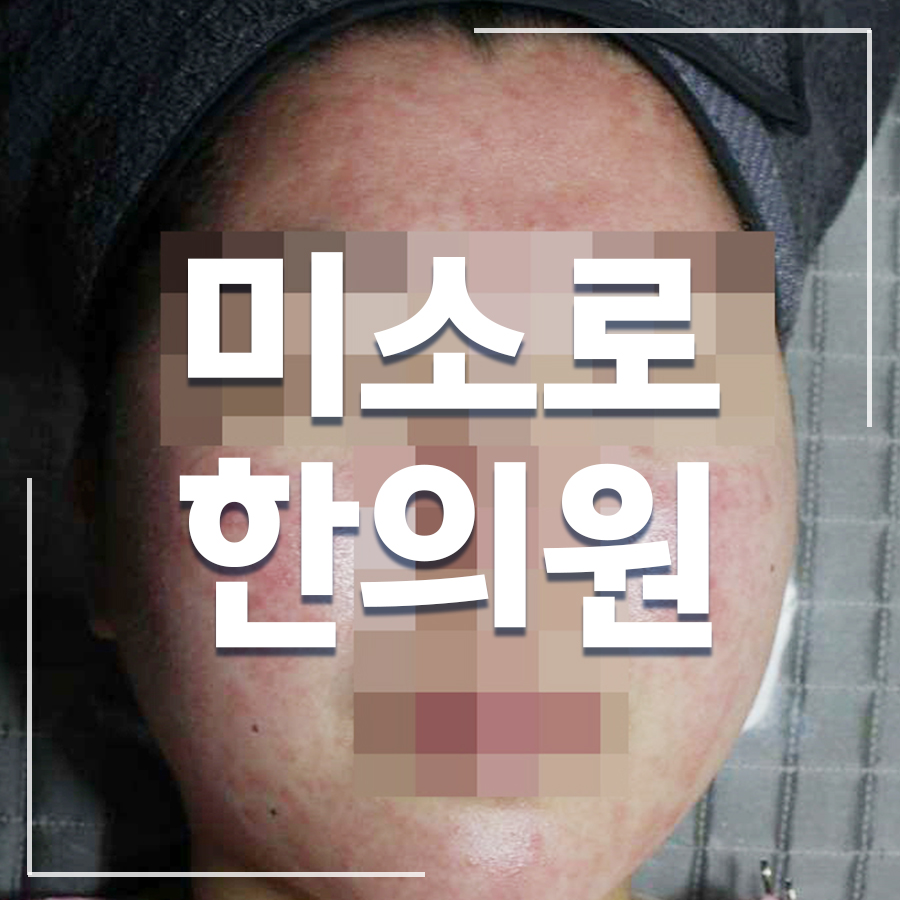 서신동 지루성피부염 병원 추천 관련 이미지 1