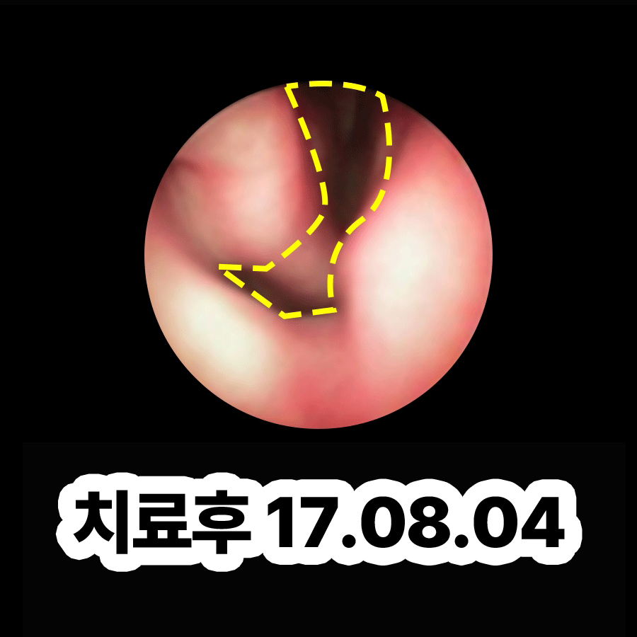 성남 부비동염 치료기간 관련 이미지 3