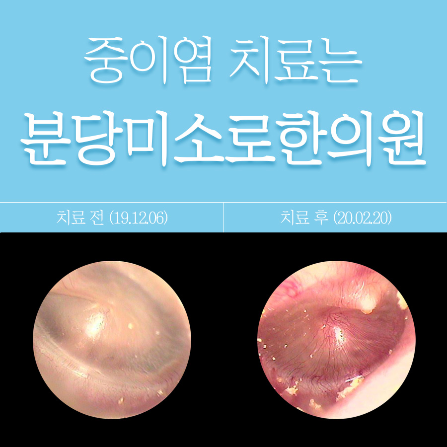 분당 중이염 약 안 먹고 관련 이미지 1