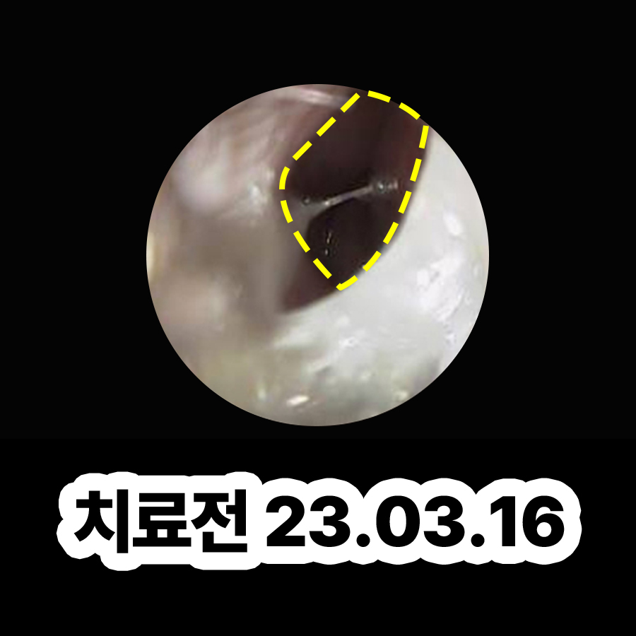 용인 축농증내시경수술비용 관련 이미지 2