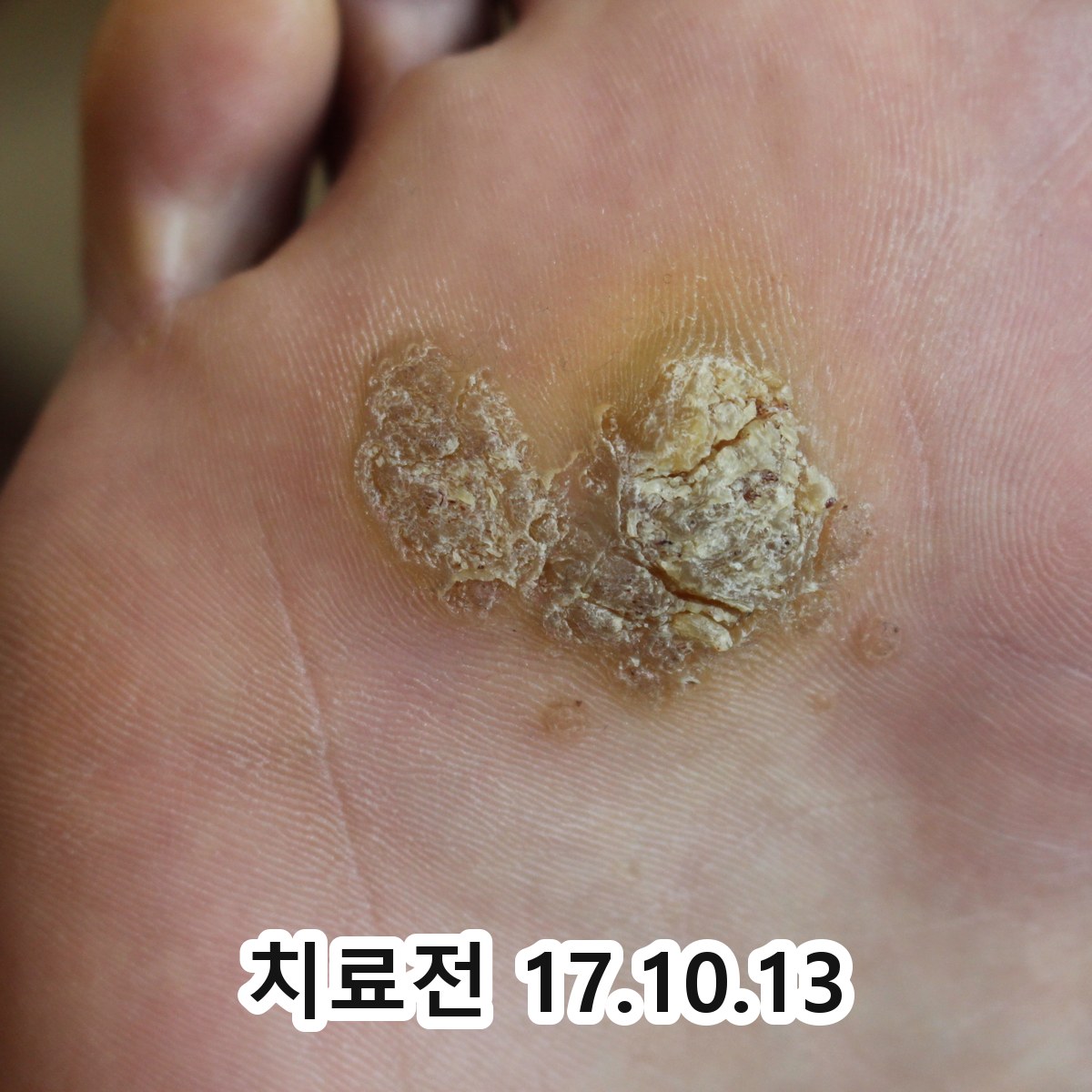 안중 편평사마귀프로폴리스 관련 이미지 2