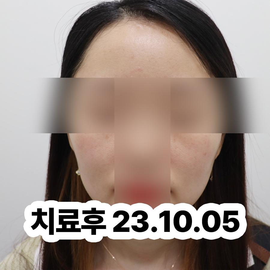 분당 남자 사타구니 습진 착색 관련 이미지 3