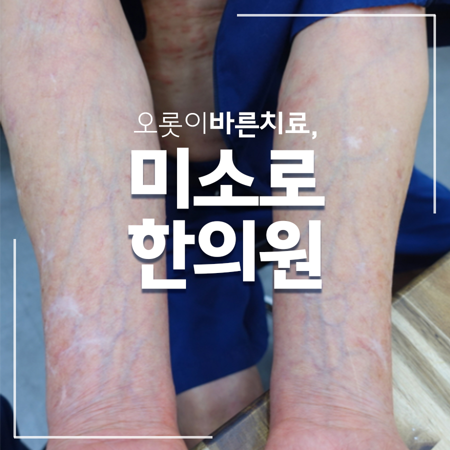이천 피부묘기증 치료 관련 이미지 1