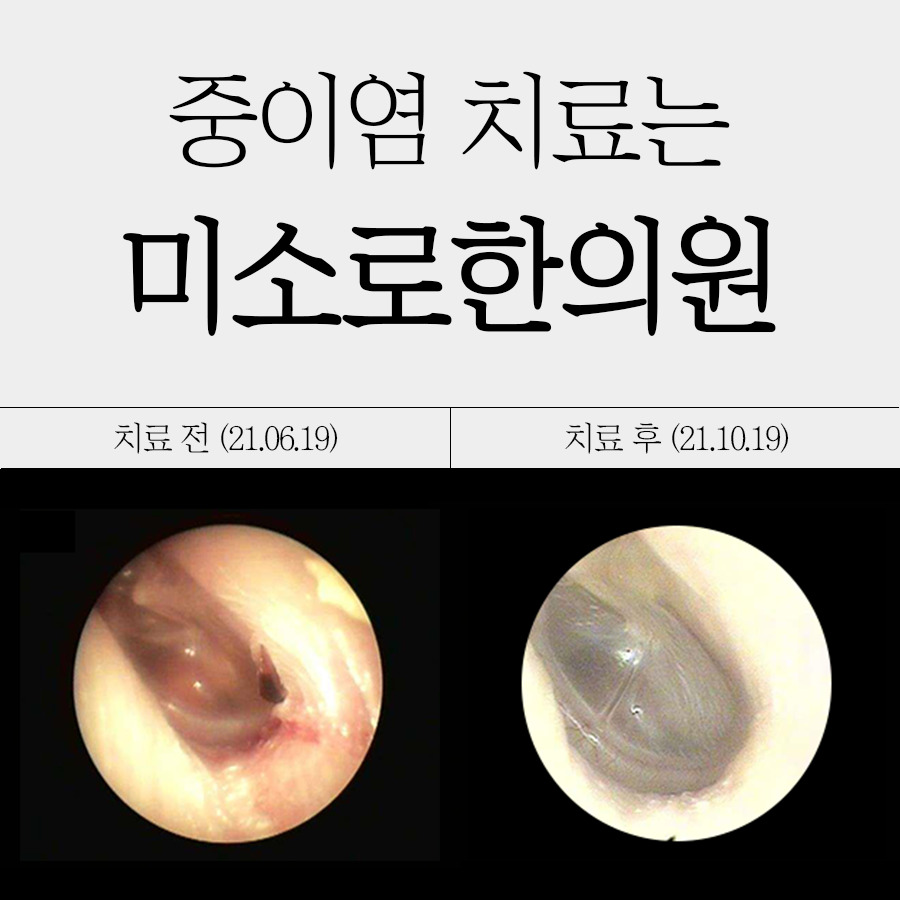 분당 만성중이염 수술 관련 이미지 1