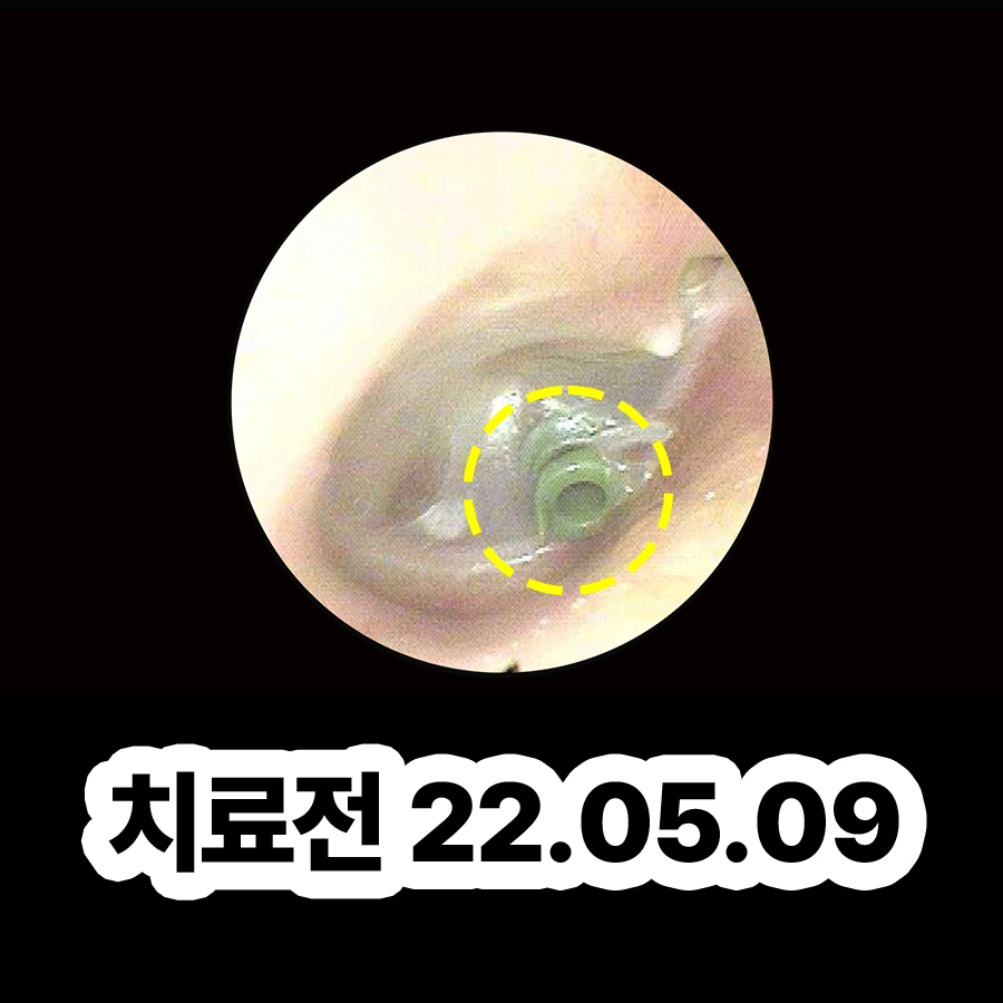 분당 소아 중이염 관련 이미지 2
