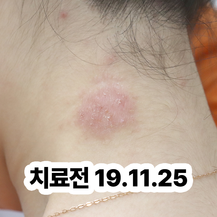 분당 성인 아토피 한의원 추천 관련 이미지 2