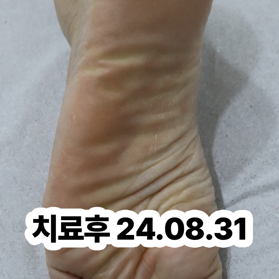 성남 한포진 치료법 관련 이미지 3