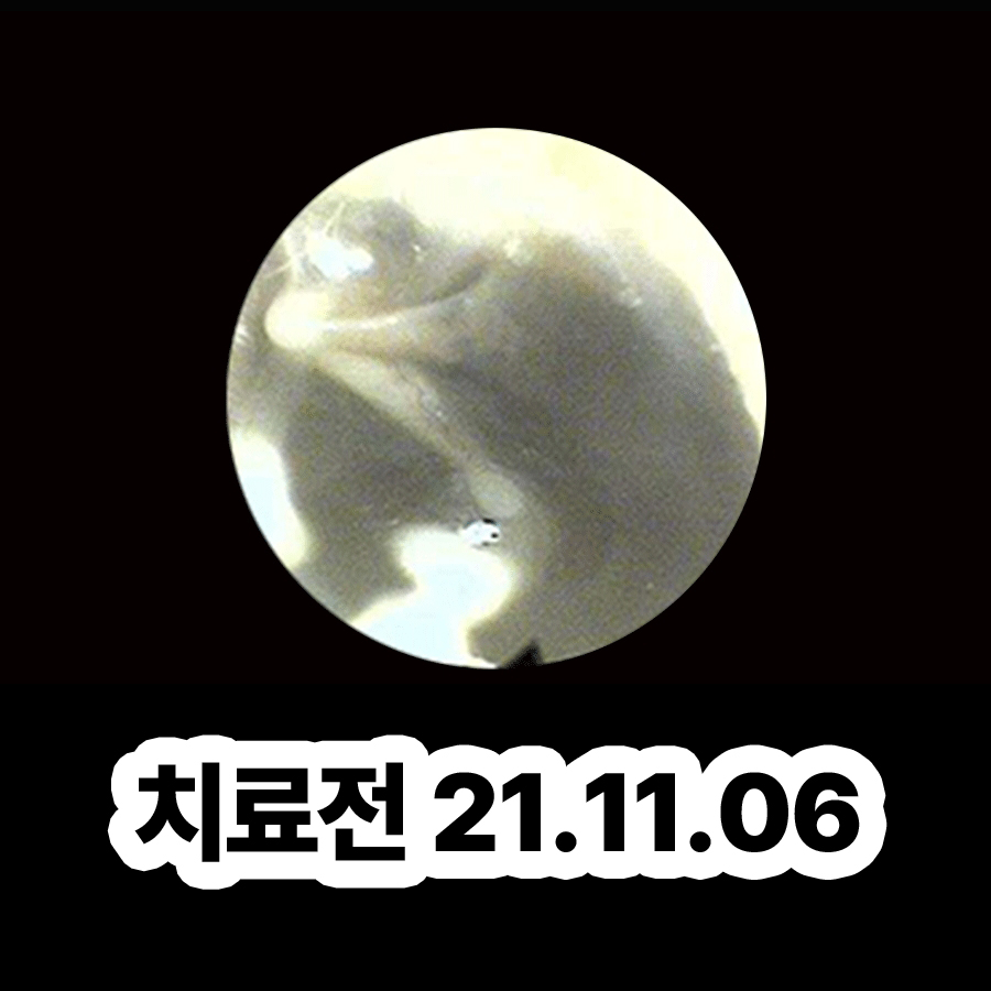 분당 중이염 약 처방 효과 관련 이미지 2