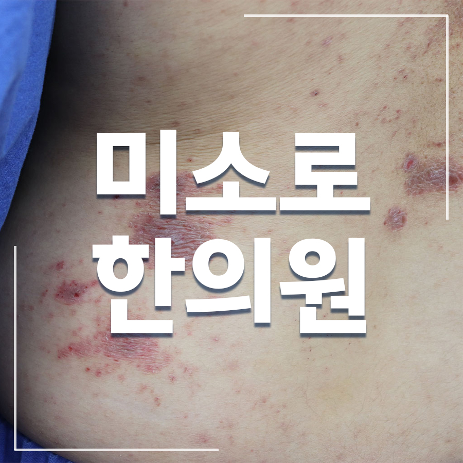 성남 사타구니 습진 연고 관련 이미지 1