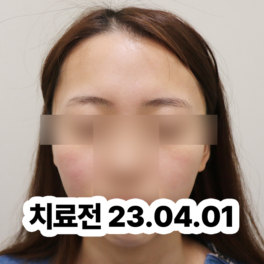 분당 성인아토피치료방법 관련 이미지 2