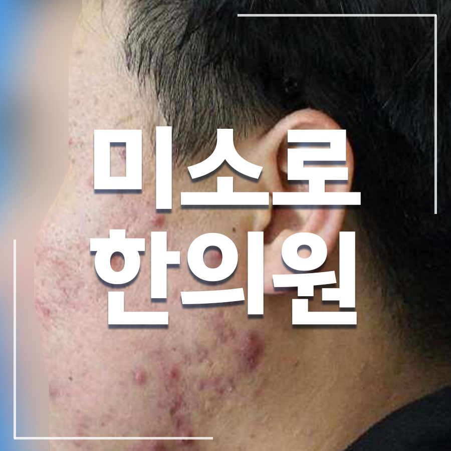 얼굴 지루성 피부염 치료