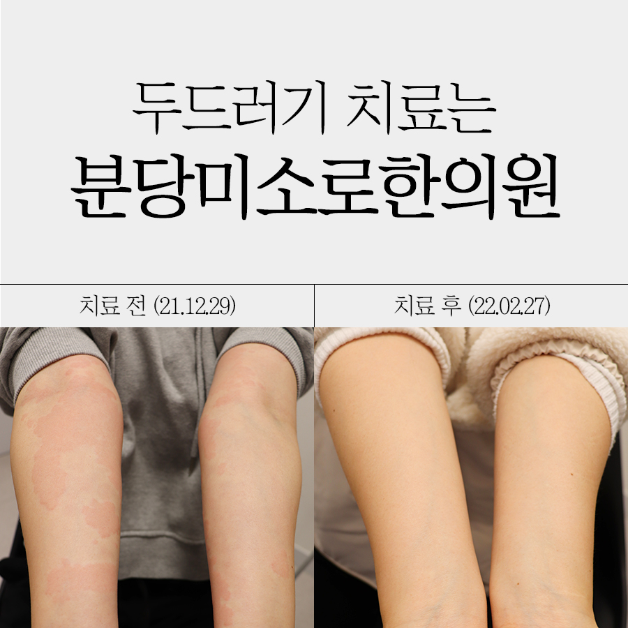 용인 한랭 두드러기 치료 방법 관련 이미지 1