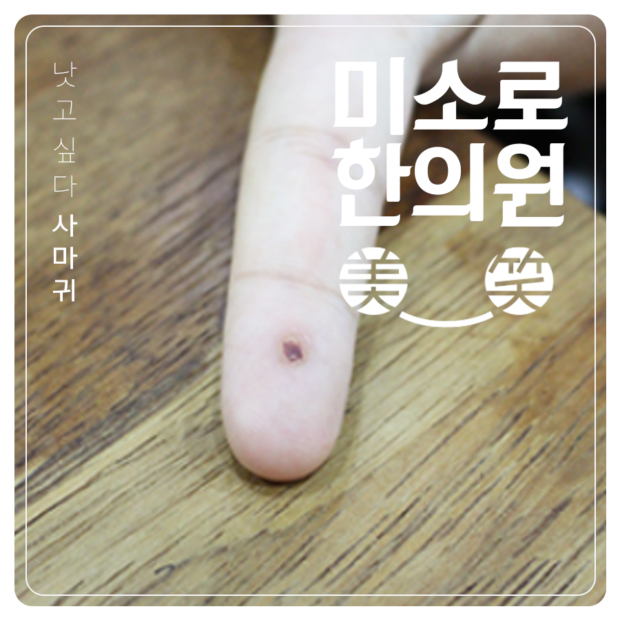 분당 얼굴 평편사마귀 레이저 관련 이미지 1