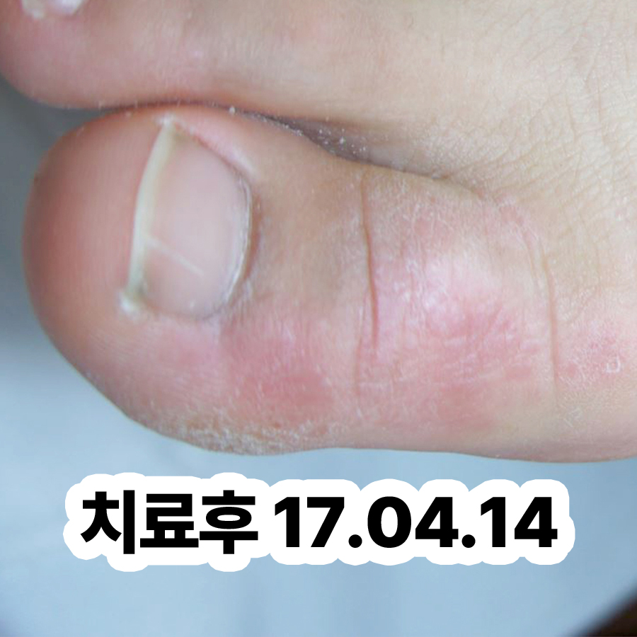 분당 사마귀 한의원 관련 이미지 3