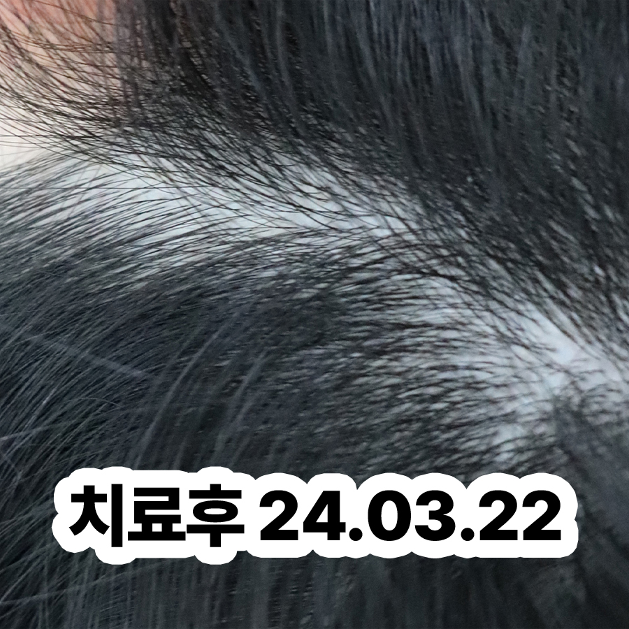 성남 두피지루성피부염피부과 관련 이미지 3