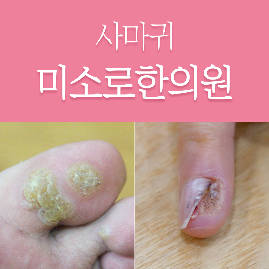 이천 편사마귀 연고 관련 이미지 1