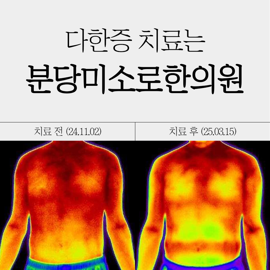 분당 미각 다한증 치료법 관련 이미지 1