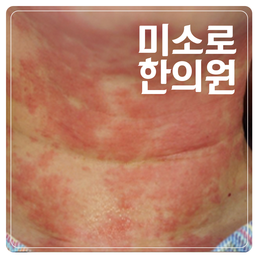 피부묘기증