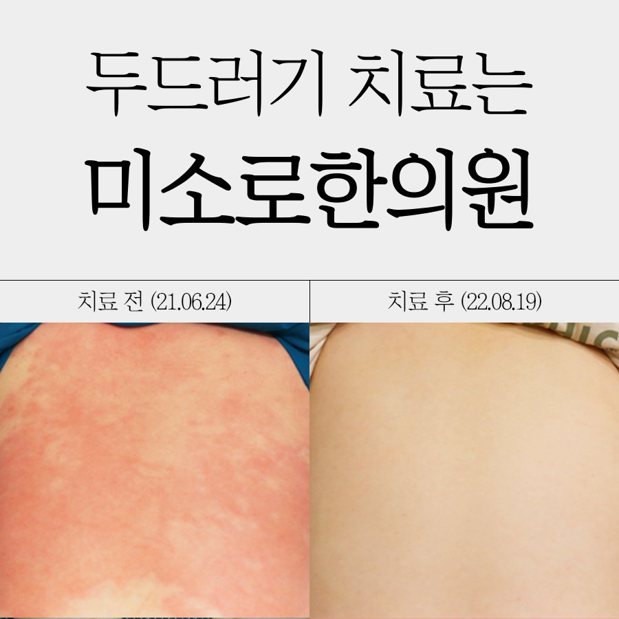 분당 두드러기 한의원 관련 이미지 1