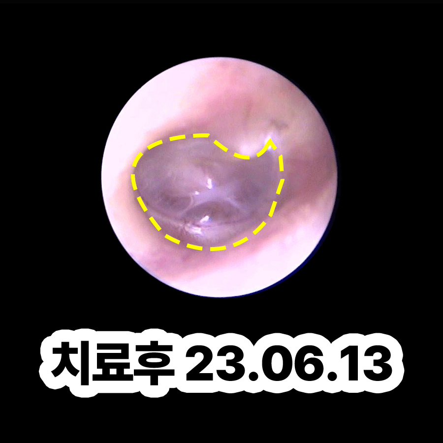 여주 만성중이염 수술방법 관련 이미지 3