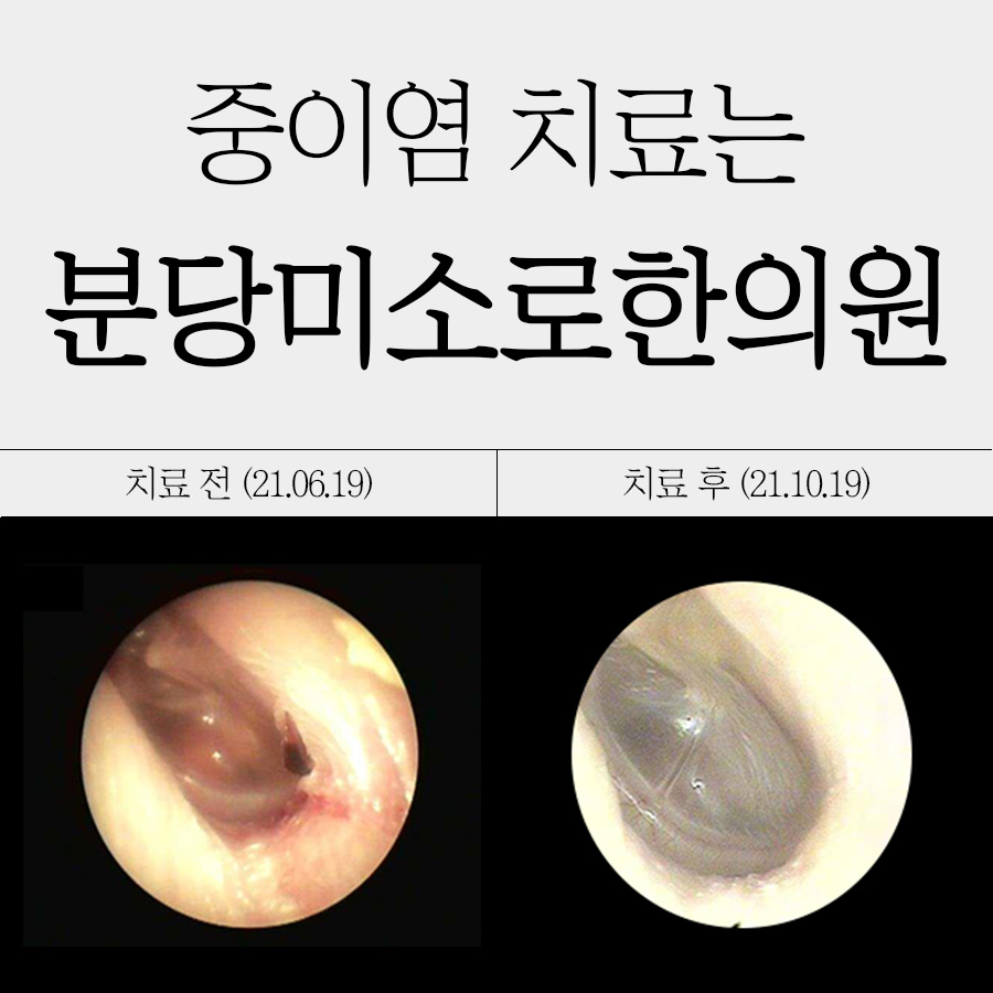 성남 만성 중이염 수술 병원 추천 관련 이미지 1