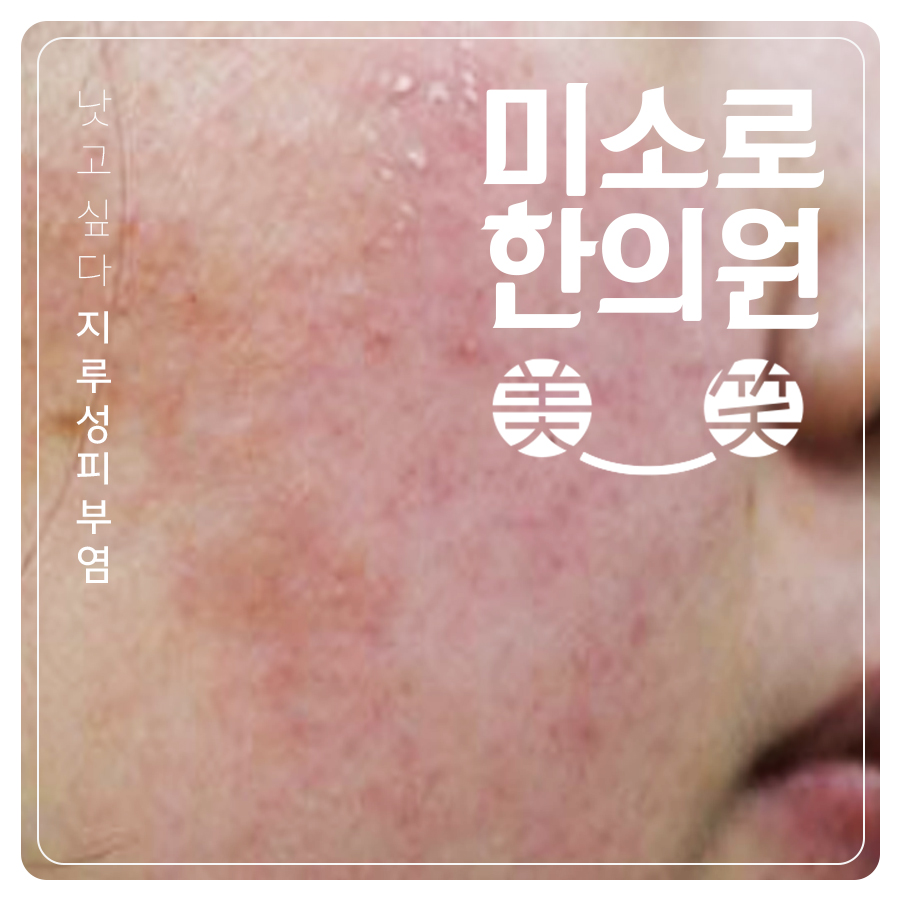 구월동 두피지루성피부염피부과 관련 이미지 1