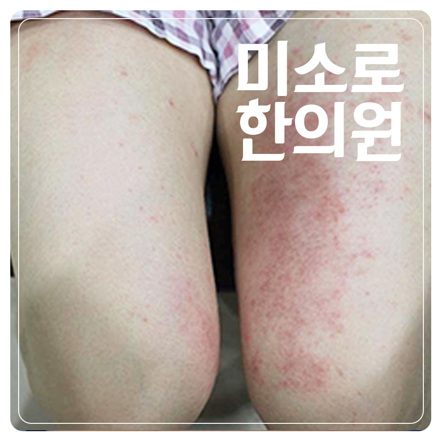 성남 피부가려움두드러기 병원 관련 이미지 1