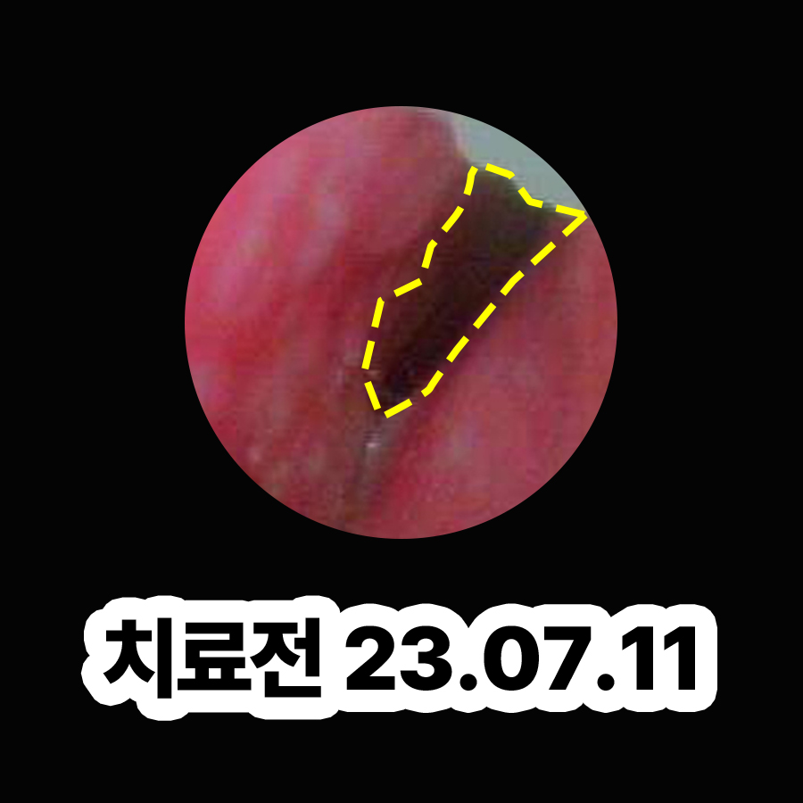 분당 비염 이비인후과 관련 이미지 2