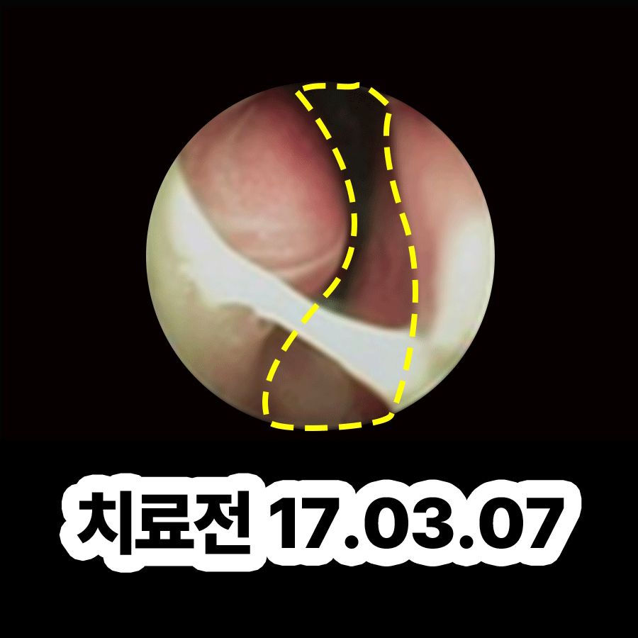 성남 곰팡이균 축농증 증세 관련 이미지 2