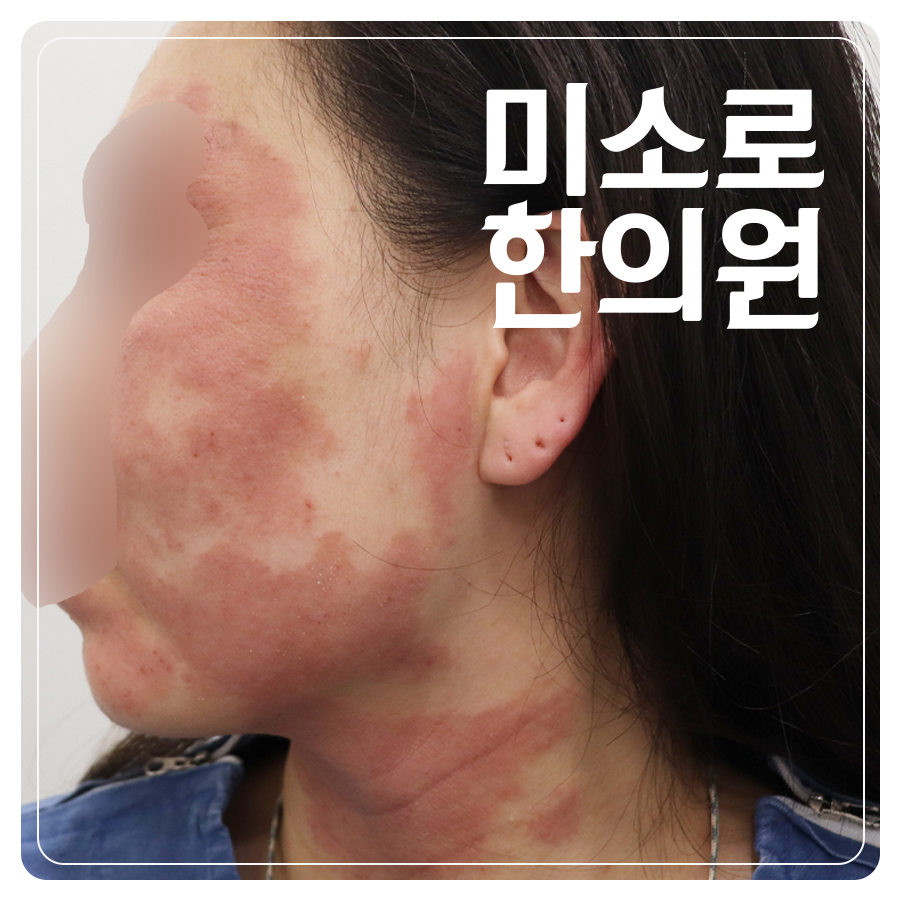위례 소아 아토피 치료 병원 관련 이미지 1