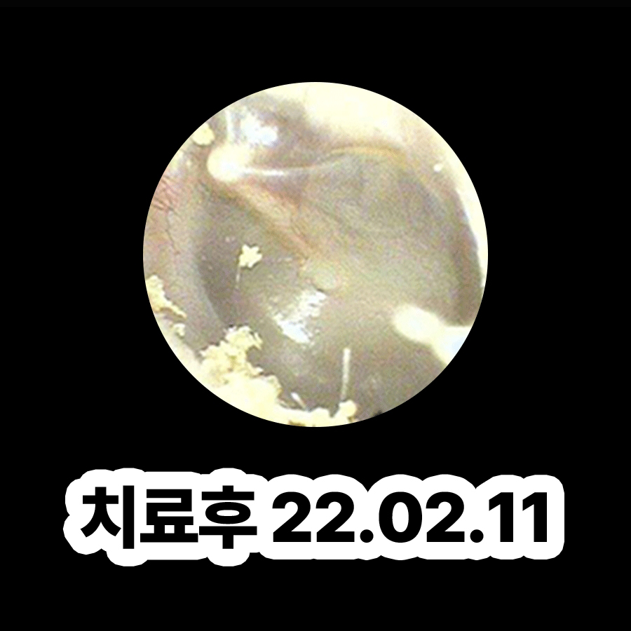 분당 중이염 약 처방 효과 관련 이미지 3