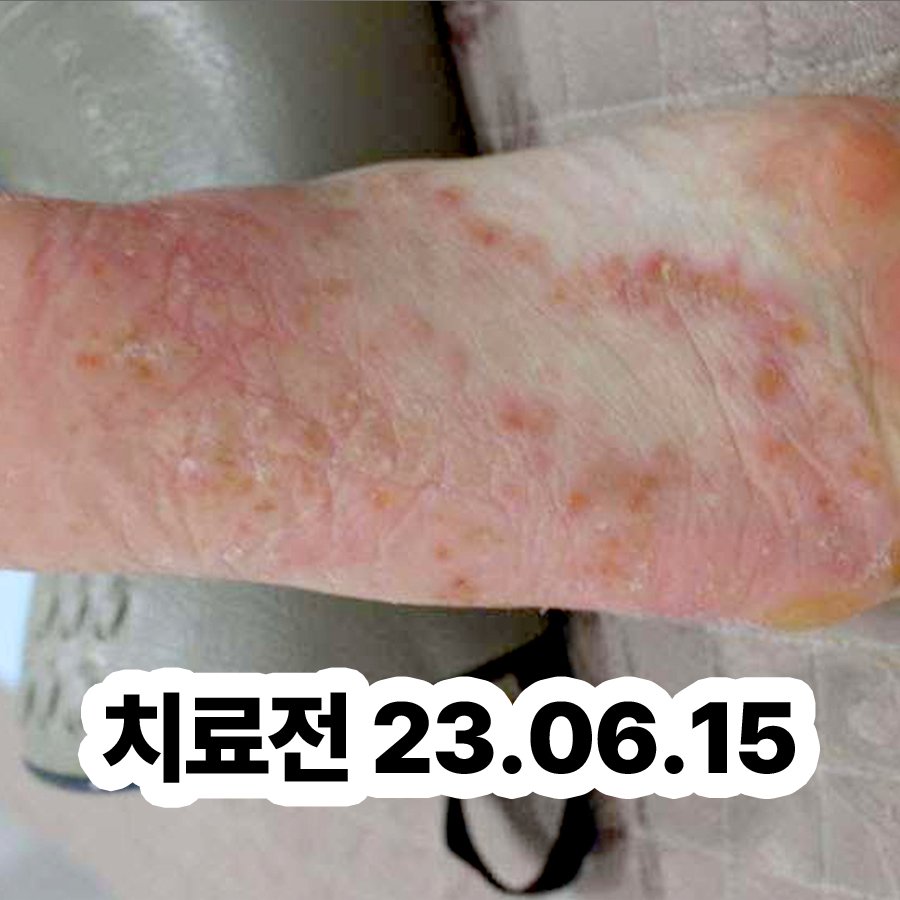 분당 한포진 한의원 관련 이미지 2